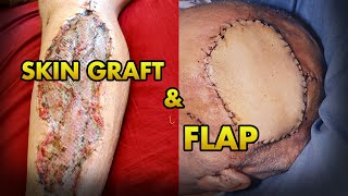 Skin Graft and Flap Explained in Details [upl. by Gold]