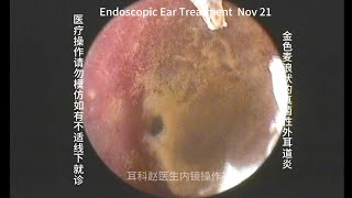 Ear wax removal Golden earwax fungus dry sheet cleaning 20241121 [upl. by Norac80]