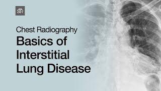 Chest Radiography Basics of Interstitial Lung Disease [upl. by Enttirb]