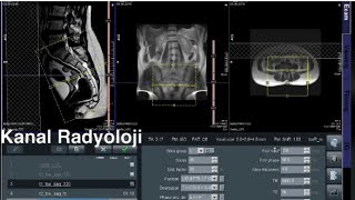 Koksiks MR Nasıl Çekilir KANAL RADYOLOJİ MR Çekmeyi Öğreniyorum Siemens Magnetom Essenza [upl. by Annala172]