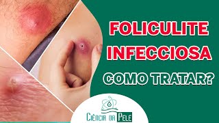 Como Tratar Foliculite Infecciosa  Saiba Tudo Sobre Essa Condição [upl. by Henn873]