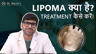 Dermatologist explains What is Lipoma  Causes amp Treatment of Lipoma Best lipoma treatment in Delhi [upl. by Yaja]