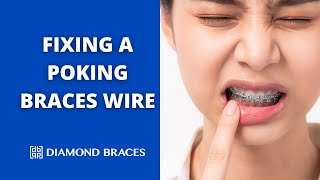 How to Fix a Long Wire Poking from Braces StepbyStep Demonstration [upl. by Alekram]