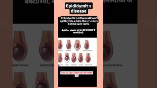 Infaction epididymis रोग treament एंटीबायोटिक एंटीवायरल रखरखाव अच्छी स्वच्छता यूरिन ट्रैक केय [upl. by Ethelin]