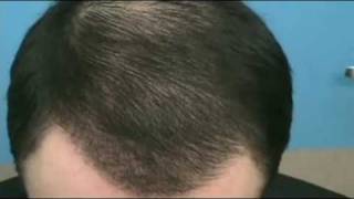 Doctor Hasson Hair Transplant  4600 Grafts at 4 Months PostOp  One Session [upl. by Iruyas]