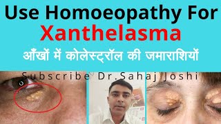 Xanthelasma Homeopathic medicine for Xanthelasma [upl. by Eugenle]