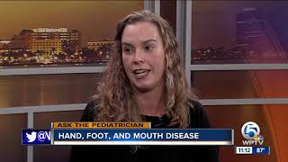 Symptoms of hand foot and mouth disease [upl. by Lezti583]