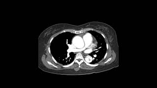 Dissecção da aorta [upl. by Douglass]