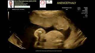 Anencephaly 25 weeks [upl. by Rosemare]