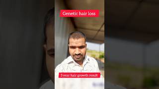 3 Years Minoxidil hair growth results 🔥shorts hairstyle hair [upl. by Latin]