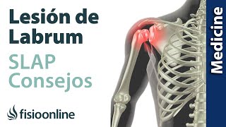 Consejos para solucionar la lesión labrum de hombro SLAP [upl. by Ykcub]