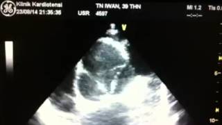 NonCoaptation Aortic Valve with Aortic Root Dilatation [upl. by Rramel256]