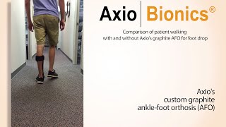 Axiobionics Custom Graphite AFO corrects foot drop [upl. by Anik]