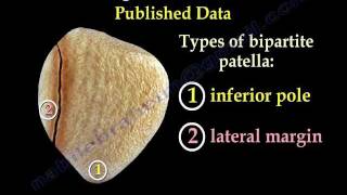 Bipartite Patella  Everything You Need To Know  Dr Nabil Ebraheim [upl. by Eliezer]