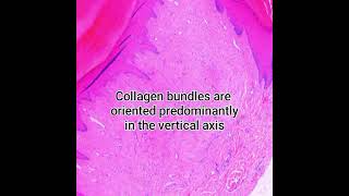 Histopathology of Acral Digital Fibrokeratoma pathology dermatopathology dermpath pathologist [upl. by Lledniw]