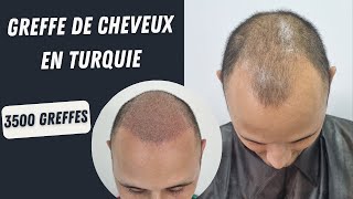 Greffe de cheveux en Turquie  Avant et après la chirurgie  Opération de greffe de cheveux [upl. by Ahseya]