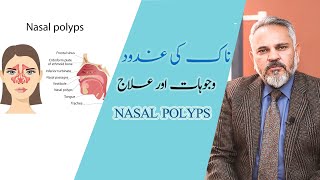 Nasal Polyps treatment in urdu I ناک کی غدود وجوہات اورعلاج I Nasal Polyps Symptoms I Naak ke Gadood [upl. by Georgi]