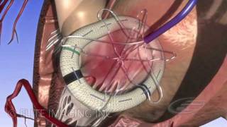 Mitral Heart Valve Ring  Medical amp Scientific Video Production [upl. by Iinde134]