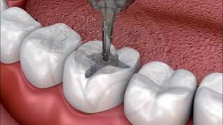 Basic Dental Restoration Cavity Filling  In English [upl. by Bergeman]