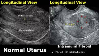 Uterus Ultrasound Normal Vs Intramural Fibroid Images  Uterine Leiomyomas USG Cases [upl. by Cope]