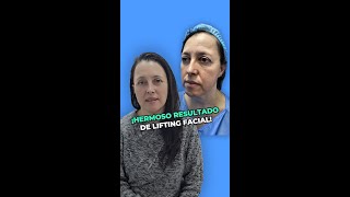 Rejuvenecimiento Facial Antes y Después ¡Increíbles Resultados [upl. by Ynnij]