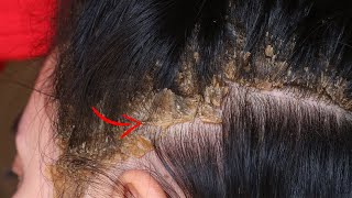 Removal A Lot Worms From Dandruff  484 [upl. by Audres]