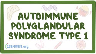 Autoimmune polyglandular syndrome type 1 [upl. by Horatius119]