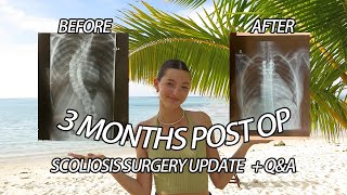 SCOLIOSIS SURGERY 3 MONTHS POST OP RECOVERY UPDATE 🤍 [upl. by Aseretairam977]