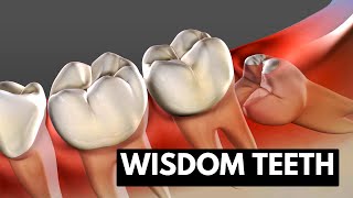 Wisdom teeth Causes Symptoms and Treatment [upl. by Pokorny]