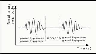 Cheyne stokes breathing in a patient with heart failure [upl. by Maxentia485]