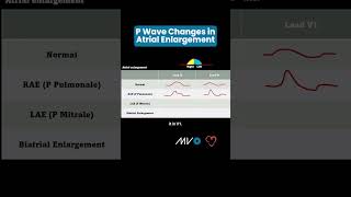 P Wave Changes in Atrial Enlargement [upl. by Akehsar]