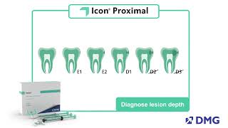 Icon Proximal Steps for Treatment [upl. by Ahsened948]