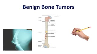 Benign Bone Tumors Made Simple [upl. by Jordain]