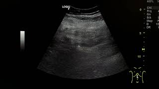 Mesenteric panniculitis [upl. by Nidorf]