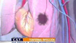 Tosferina una infección respiratoria aguda  NTN24com [upl. by Binette176]