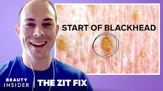 Dermatologist Explains What We See In Our Pores Under A Microscope  The Zit Fix [upl. by Charity]