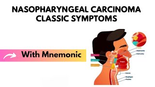 Nasopharyngeal Carcinoma Classic Symptoms With Mnemonic  ENT Mnemonics  Dr Mubashar Ata [upl. by Nemsaj]