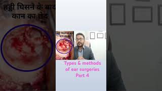 Part 4 types and methods of ear surgeries shortsviral [upl. by Aihsakal]