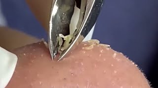 Deep Dive Blackhead Removal The Tweezer Method [upl. by Oinotna216]