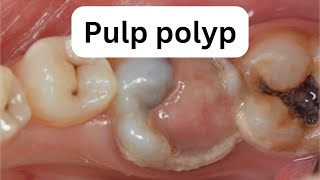 Why You Should Take Pulp Polyp Warning Signs Seriously [upl. by Mylander]