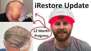 IRESTORE LASER HAIR GROWTH THERAPY 12  MONTH UPDATE  Before and After Comparison [upl. by Gunner]