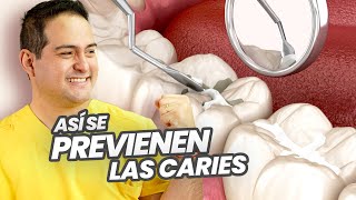 EL SELLADOR o SELLANTE DENTAL DE FOSAS Y FISURAS ¿es BUENO o MALO ¡HABLAN LOS ESPECIALISTAS [upl. by Gustin]