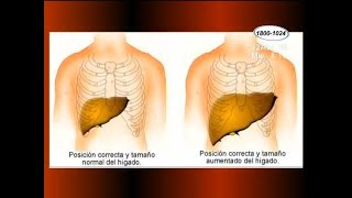 Salud ¿Qué es la hepatomegalia [upl. by Auhsoj85]