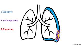 Empyema and Pleural Effusions [upl. by Rats]