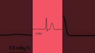 Hyperkalemia ECG Findings  Shorts [upl. by Ahsilla]