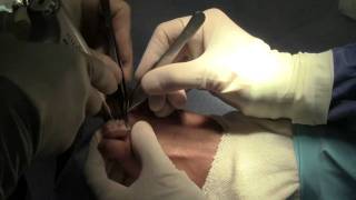 Watch Dr Sherman Nagler preform a hammer toe surgery [upl. by Tade]