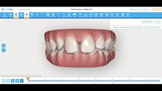 Invisalign Deep Bite and Diastema Correction How I engineer tooth movement Nirenblatt Orthodontics [upl. by Marcin]