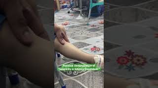 Spasticity is Velocity Dependent  Practical Demonstration [upl. by Eudoxia]