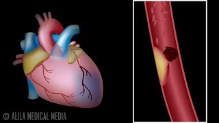 Myocardial Infarction and Coronary Angioplasty Treatment Animation [upl. by Sirtemed]