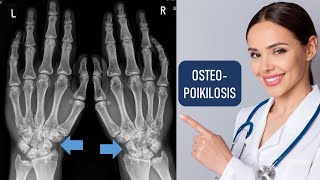 Osteopoikilosis  Sclerosing Bony Dysplasia  Xray Hand [upl. by Colville]